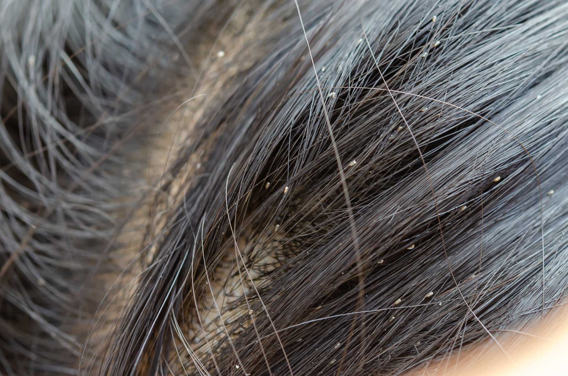 Los huevos de los piojos, ¿cómo distinguirlos de la caspa? Blog
